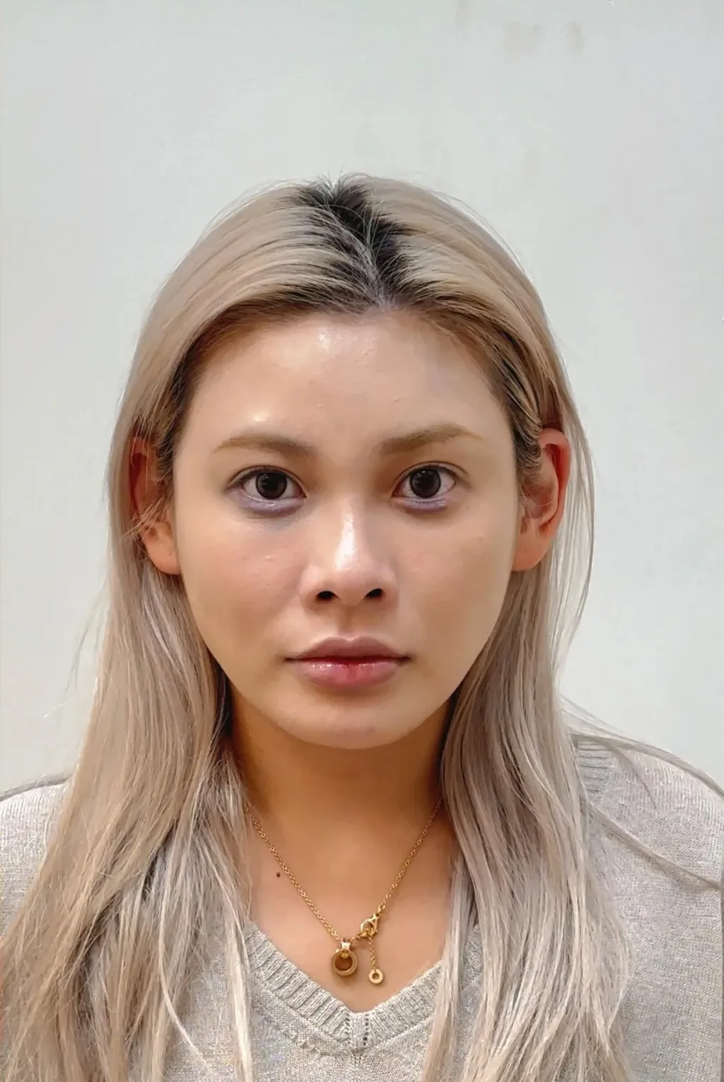 Temple Hollowing — After Treatment · Case 02 · Luowei Medical Aesthetics Clinic