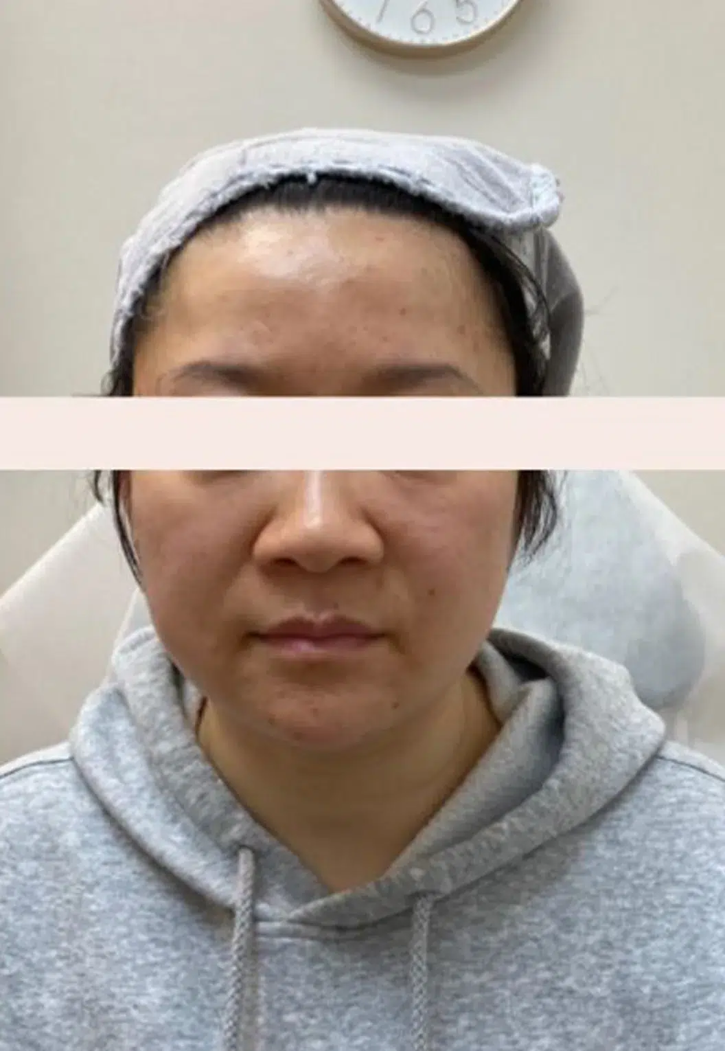 Forehead Lines — Before Treatment · Case 01 · Luowei Medical Aesthetics Clinic