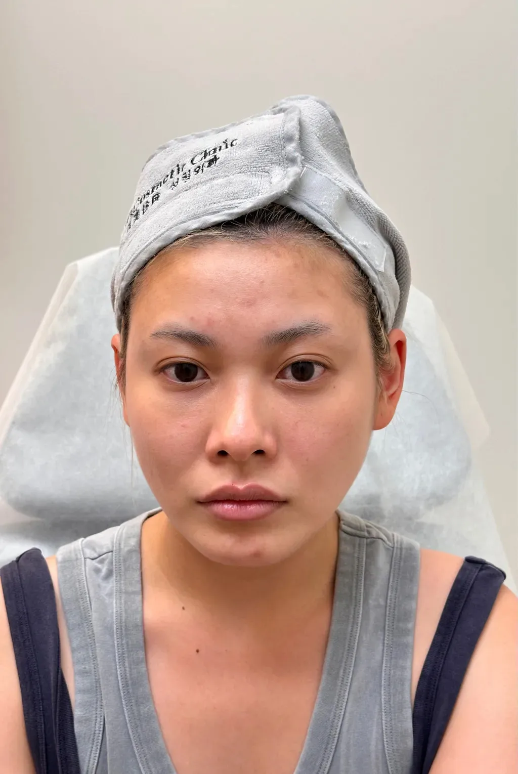 Temple Hollowing — Before Treatment · Case 02 · Luowei Medical Aesthetics Clinic
