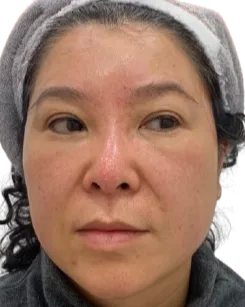 Forehead Lines — After Treatment · Case 03 · Luowei Medical Aesthetics Clinic