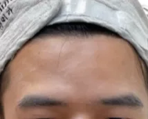 Forehead Lines — After Treatment · Case 04 · Luowei Medical Aesthetics Clinic