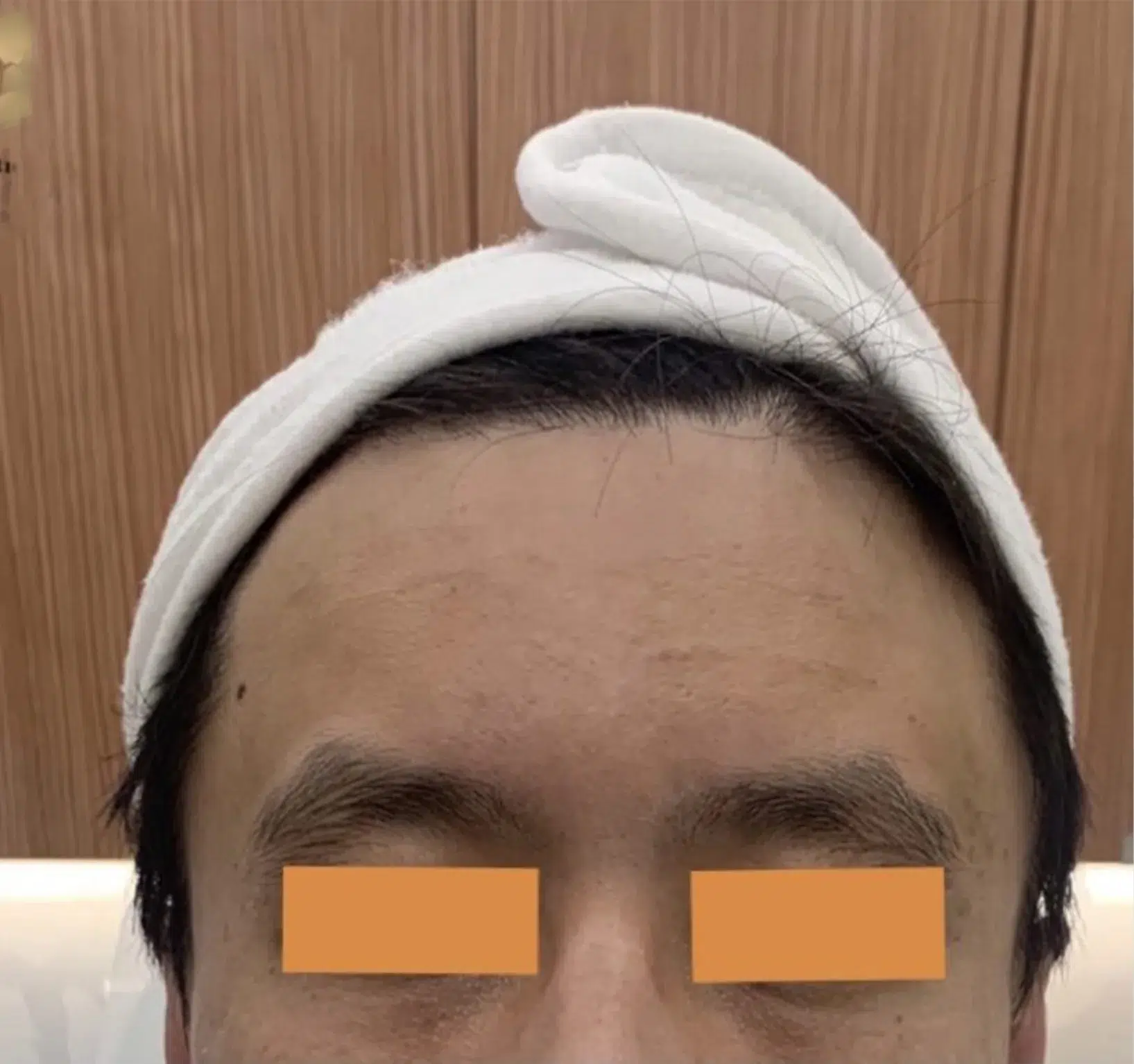Forehead Lines — After Treatment · Case 05 · Luowei Medical Aesthetics Clinic