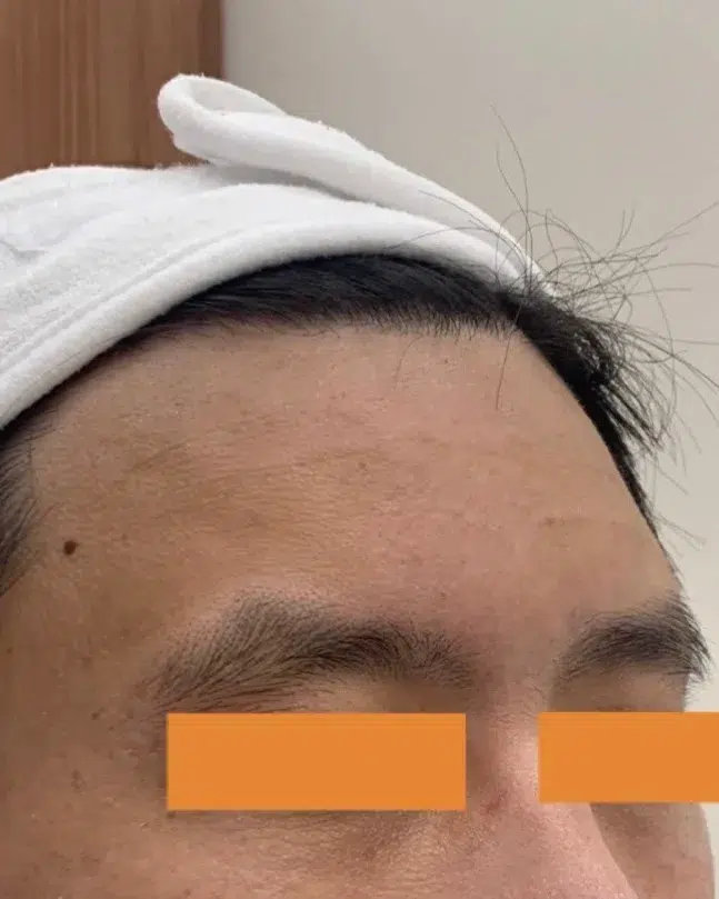 Forehead Lines — After Treatment · Case 06 · Luowei Medical Aesthetics Clinic