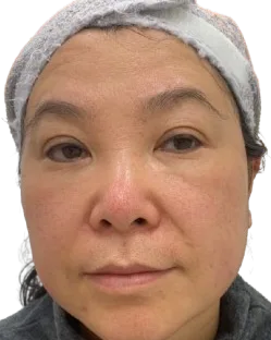 Forehead Lines — Before Treatment · Case 03 · Luowei Medical Aesthetics Clinic