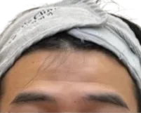 Forehead Lines — Before Treatment · Case 04 · Luowei Medical Aesthetics Clinic