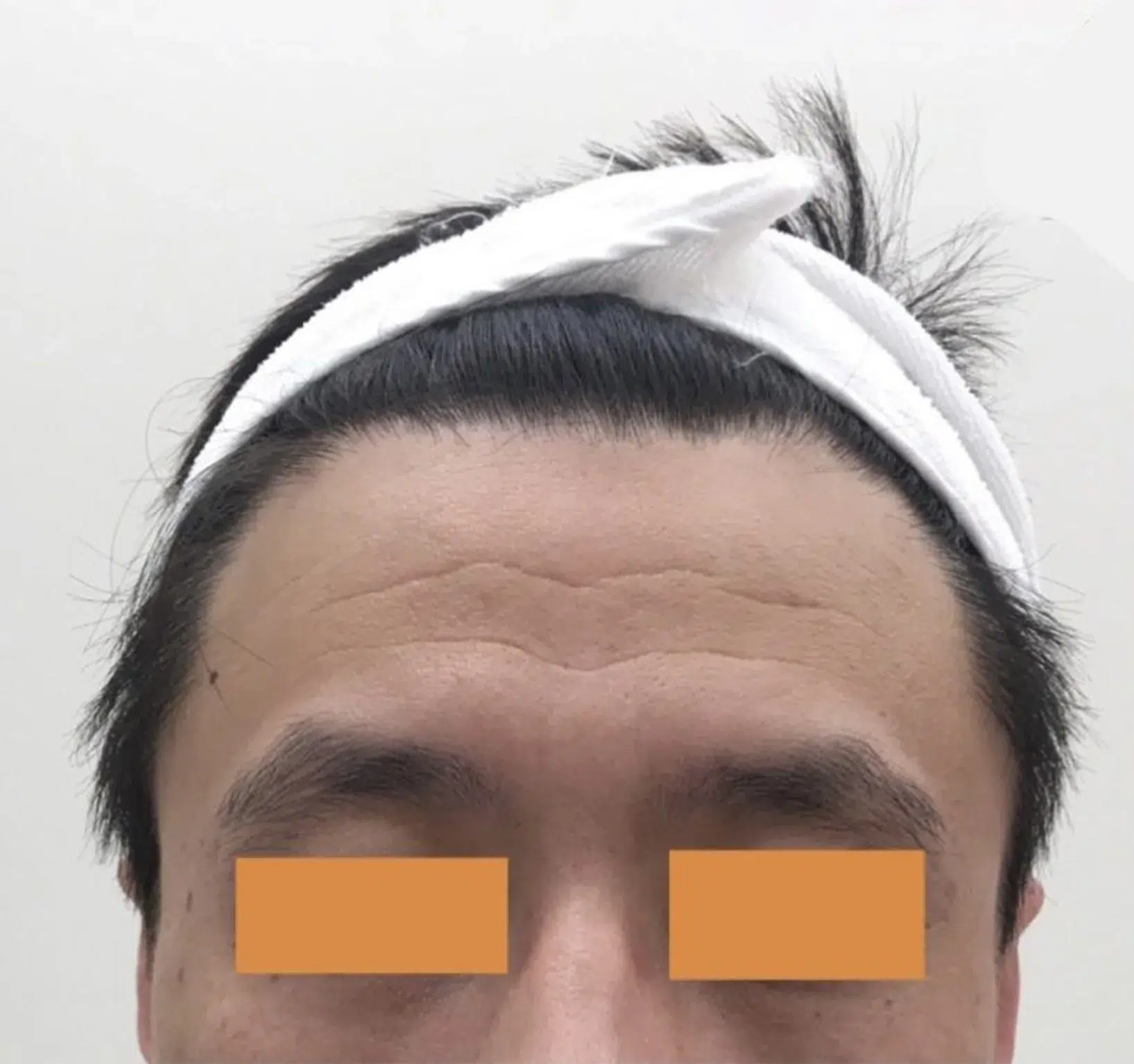 Forehead Lines — Before Treatment · Case 05 · Luowei Medical Aesthetics Clinic