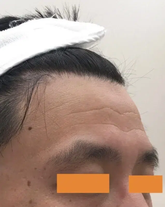 Forehead Lines — Before Treatment · Case 06 · Luowei Medical Aesthetics Clinic