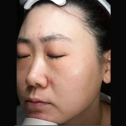 Freckles After Treatment · Case 03 · Luowei Medical Aesthetics Clinic