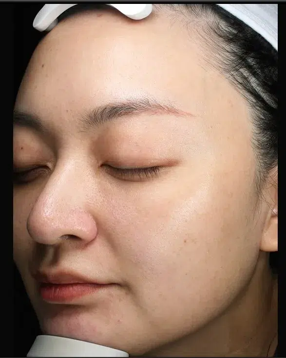 Freckles After Treatment · Case 04 · Luowei Medical Aesthetics Clinic