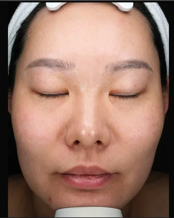 Freckles After Treatment · Case 05 · Luowei Medical Aesthetics Clinic