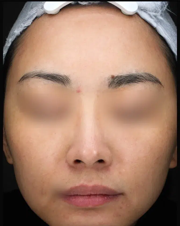 Freckles After Treatment · Case 07 · Luowei Medical Aesthetics Clinic