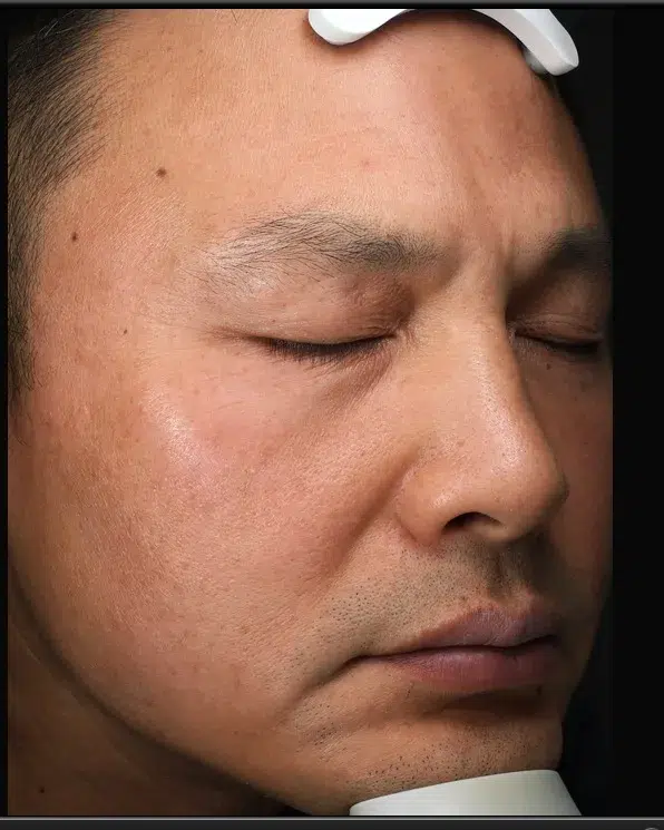 Freckles After Treatment · Case 09 · Luowei Medical Aesthetics Clinic