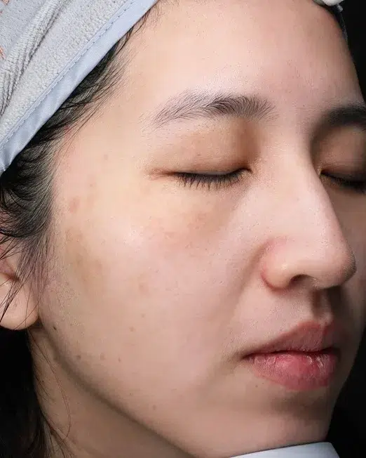 Melasma After Treatment · Case 11 · Luowei Medical Aesthetics Clinic