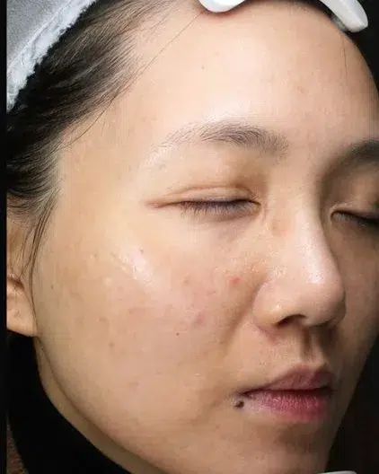Freckles After Treatment · Case 12 · Luowei Medical Aesthetics Clinic