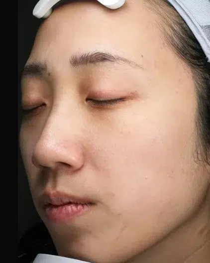 Freckles After Treatment · Case 13 · Luowei Medical Aesthetics Clinic