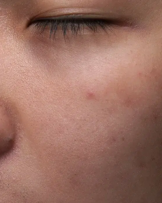 Freckles After Treatment · Case 15 · Luowei Medical Aesthetics Clinic