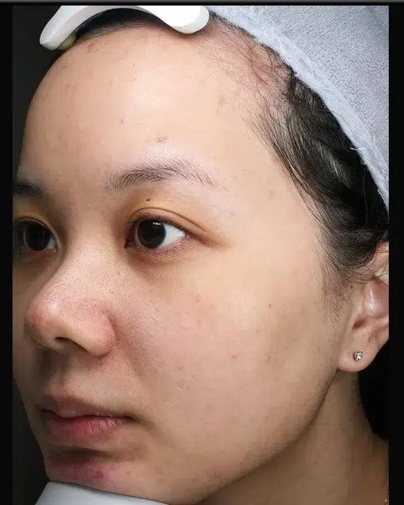 Freckles After Treatment · Case 16 · Luowei Medical Aesthetics Clinic