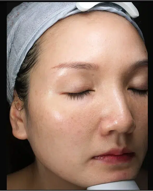Freckles After Treatment · Case 17 · Luowei Medical Aesthetics Clinic
