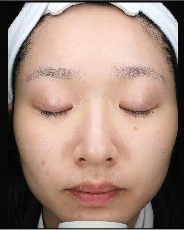 Freckles After Treatment · Case 18 · Luowei Medical Aesthetics Clinic