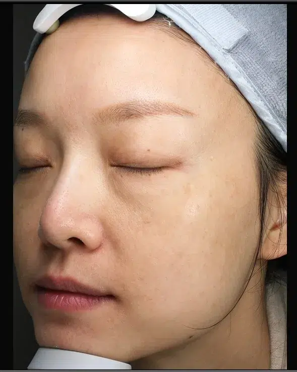 Freckles After Treatment · Case 19 · Luowei Medical Aesthetics Clinic