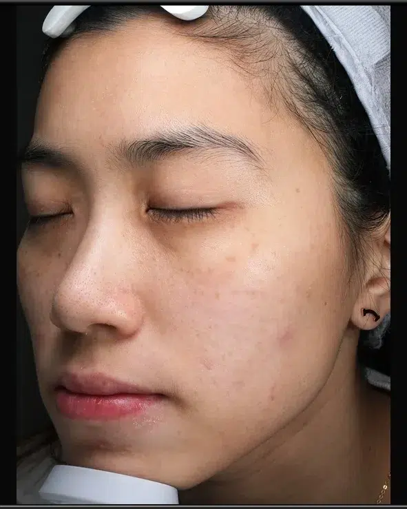 Freckles After Treatment · Case 20 · Luowei Medical Aesthetics Clinic