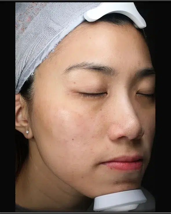 Freckles After Treatment · Case 21 · Luowei Medical Aesthetics Clinic