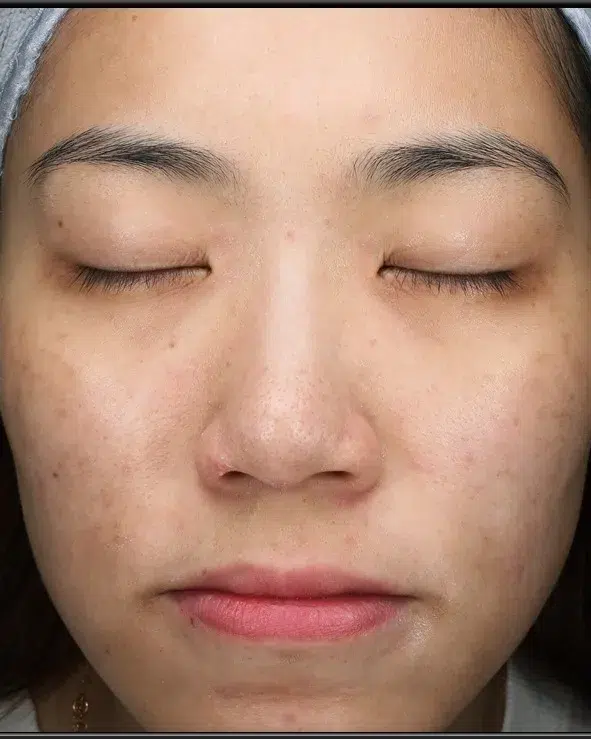 Freckles After Treatment · Case 22 · Luowei Medical Aesthetics Clinic