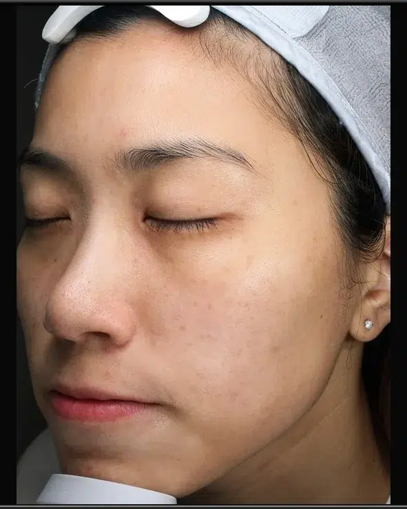 Freckles After Treatment · Case 23 · Luowei Medical Aesthetics Clinic
