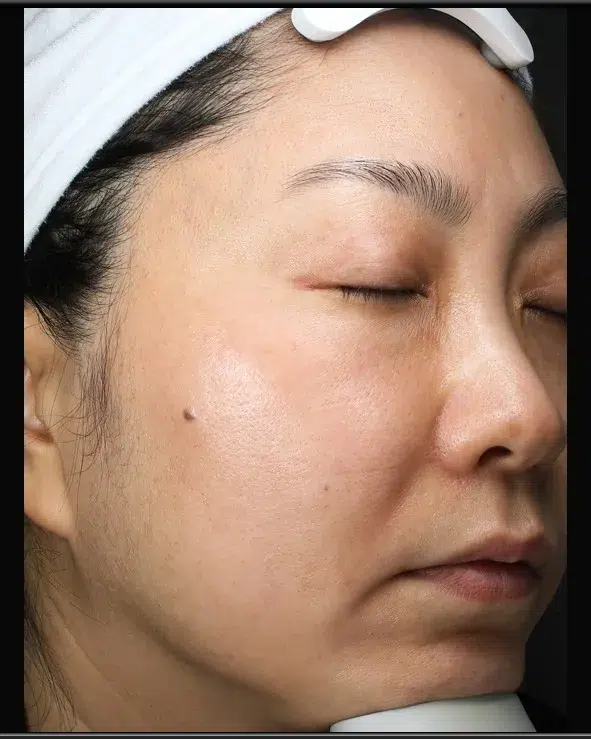 Freckles After Treatment · Case 29 · Luowei Medical Aesthetics Clinic