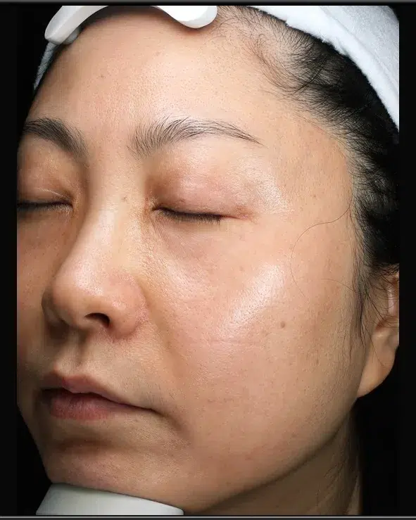 Freckles After Treatment · Case 31 · Luowei Medical Aesthetics Clinic