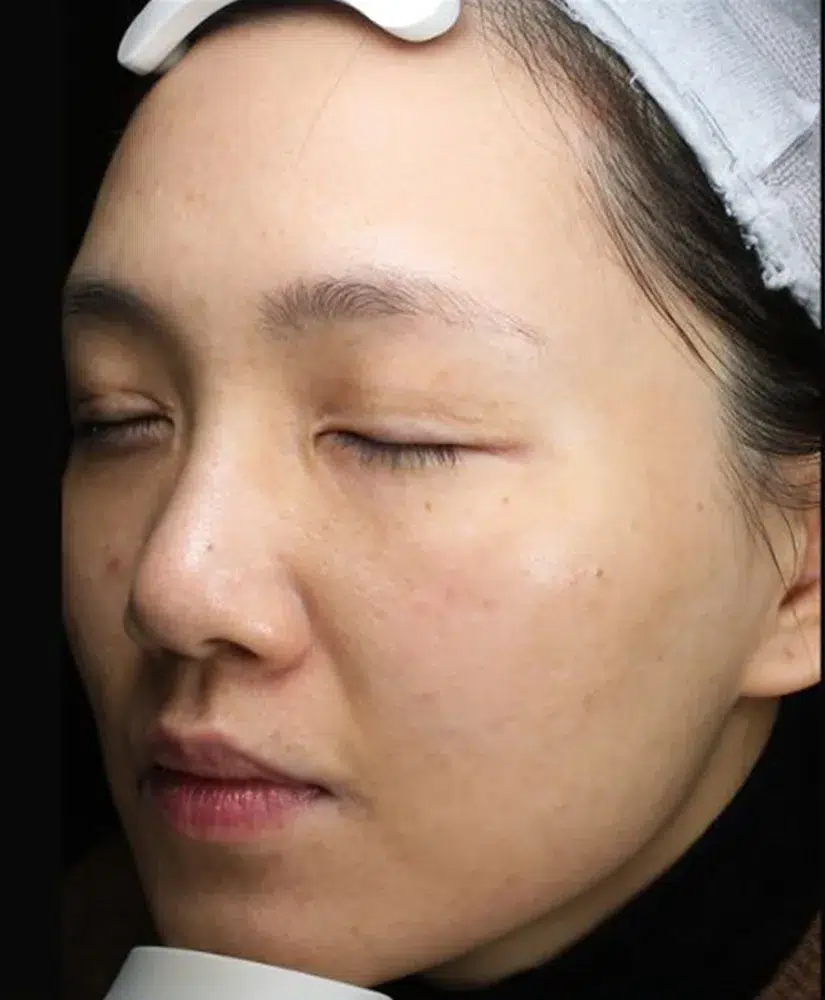 Freckles After Treatment · Case 32 · Luowei Medical Aesthetics Clinic