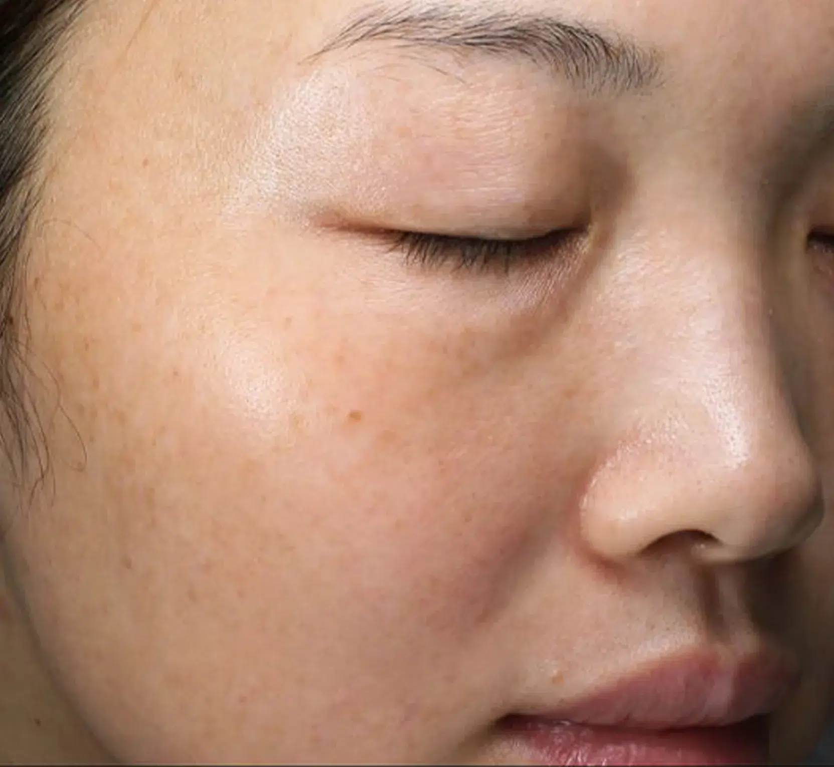 Freckles After Treatment · Case 33 · Luowei Medical Aesthetics Clinic