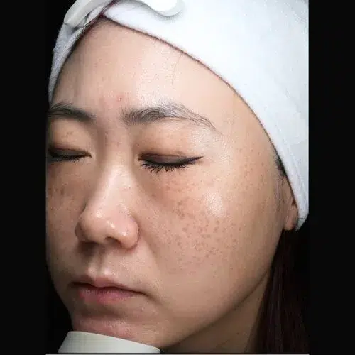 Freckles Before Treatment · Case 03 · Luowei Medical Aesthetics Clinic