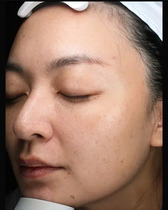 Freckles Before Treatment · Case 04 · Luowei Medical Aesthetics Clinic