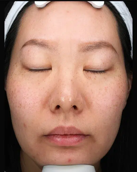 Freckles Before Treatment · Case 05 · Luowei Medical Aesthetics Clinic