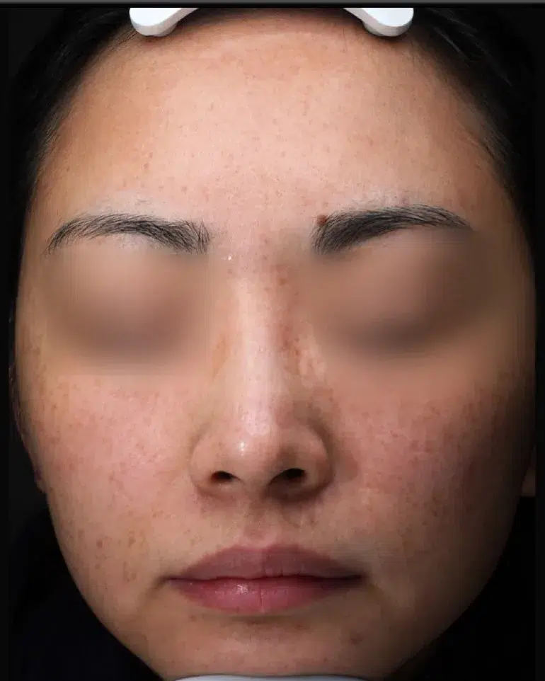 Freckles Before Treatment · Case 07 · Luowei Medical Aesthetics Clinic