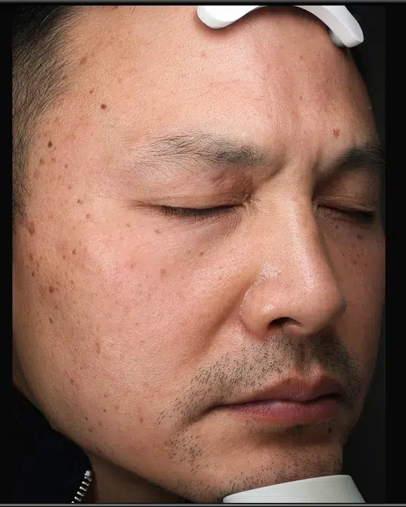 Freckles Before Treatment · Case 09 · Luowei Medical Aesthetics Clinic