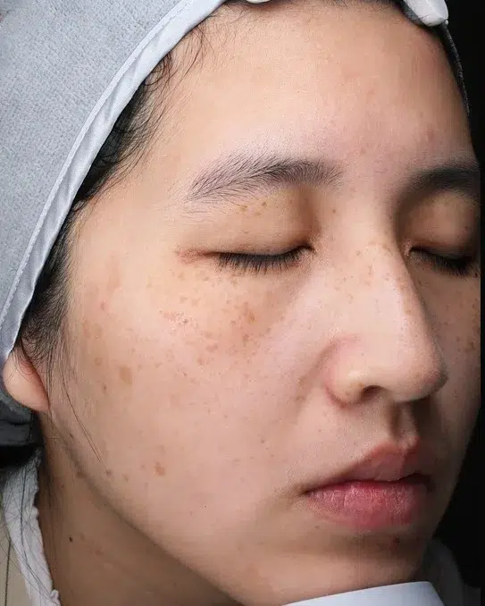 Melasma Before Treatment · Case 11 · Luowei Medical Aesthetics Clinic