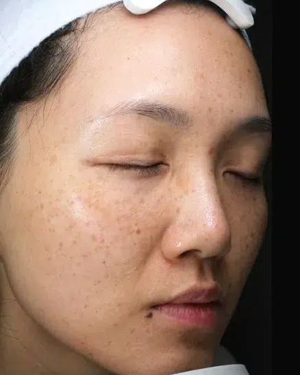 Freckles Before Treatment · Case 12 · Luowei Medical Aesthetics Clinic