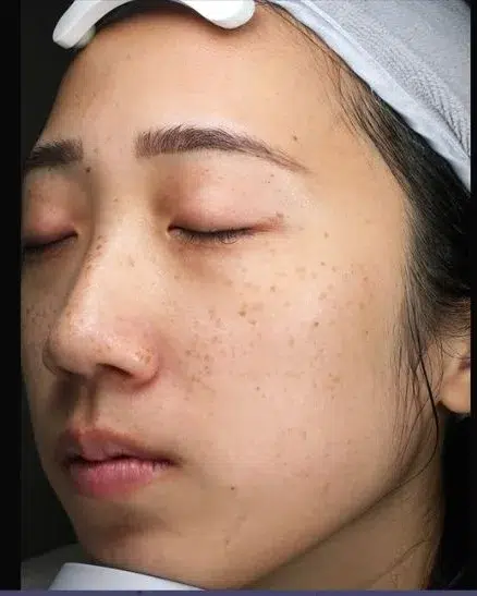 Freckles Before Treatment · Case 13 · Luowei Medical Aesthetics Clinic