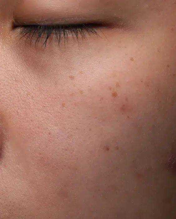 Freckles Before Treatment · Case 15 · Luowei Medical Aesthetics Clinic