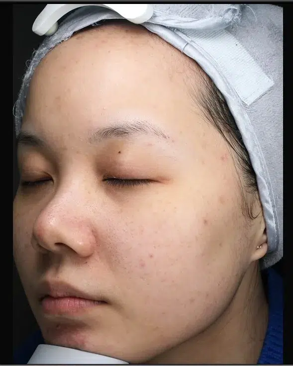 Freckles Before Treatment · Case 16 · Luowei Medical Aesthetics Clinic