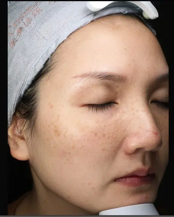 Freckles Before Treatment · Case 17 · Luowei Medical Aesthetics Clinic