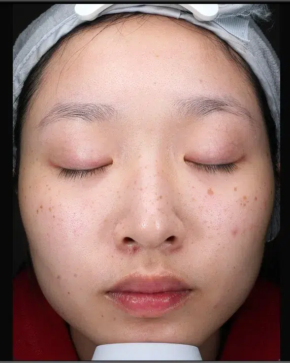Freckles Before Treatment · Case 18 · Luowei Medical Aesthetics Clinic
