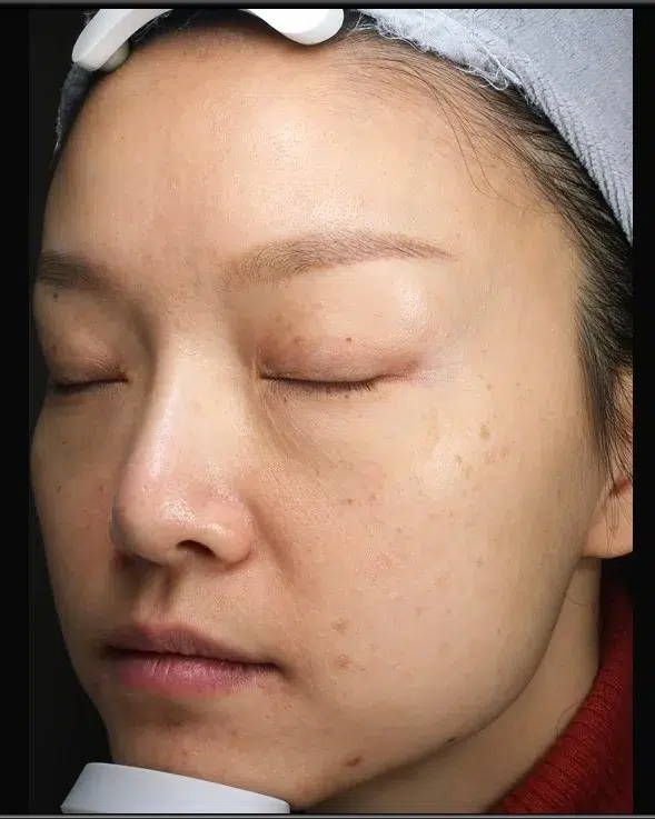 Freckles Before Treatment · Case 19 · Luowei Medical Aesthetics Clinic