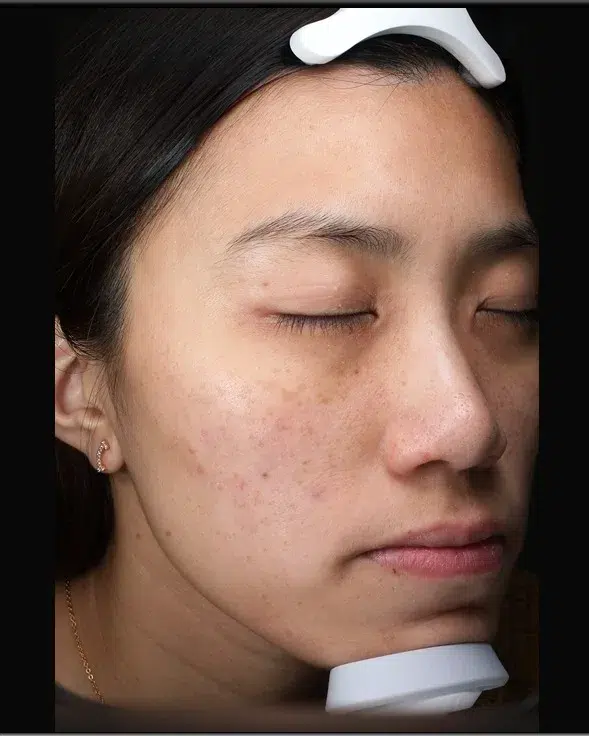 Freckles Before Treatment · Case 21 · Luowei Medical Aesthetics Clinic