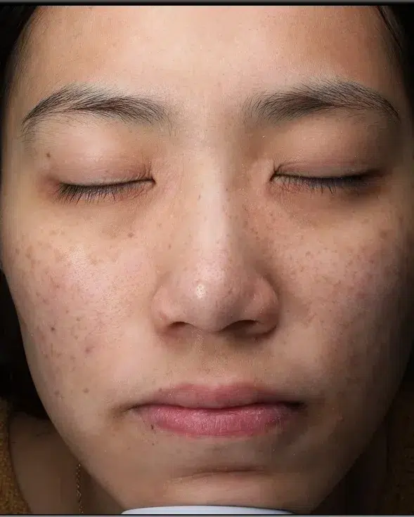 Freckles Before Treatment · Case 22 · Luowei Medical Aesthetics Clinic