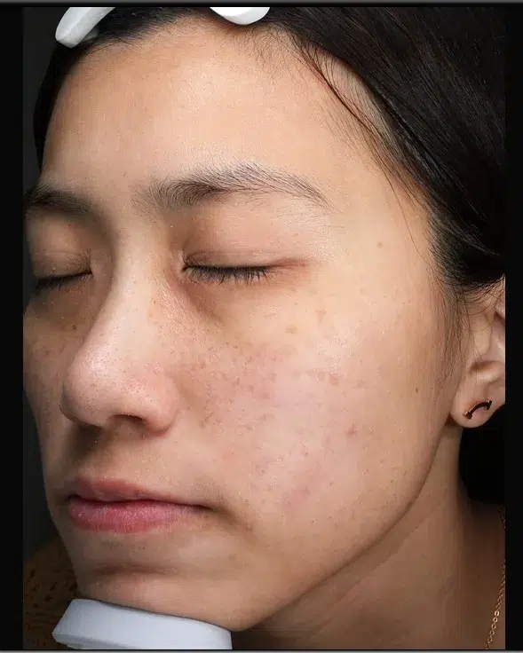 Freckles Before Treatment · Case 23 · Luowei Medical Aesthetics Clinic