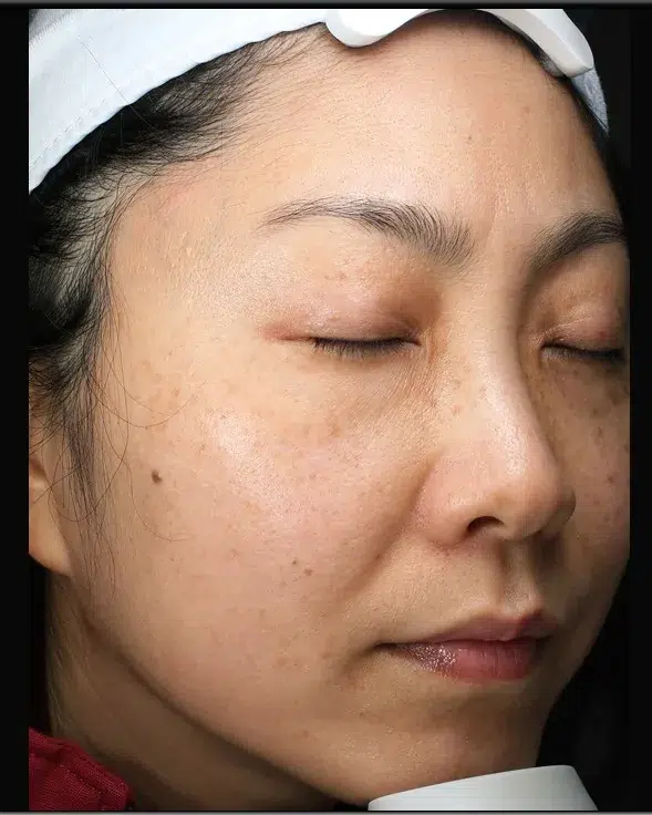 Freckles Before Treatment · Case 29 · Luowei Medical Aesthetics Clinic