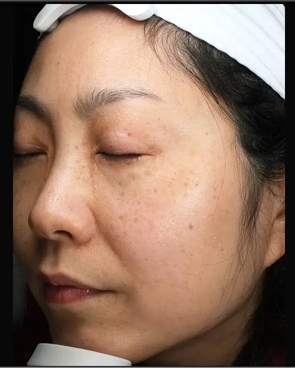 Freckles Before Treatment · Case 31 · Luowei Medical Aesthetics Clinic
